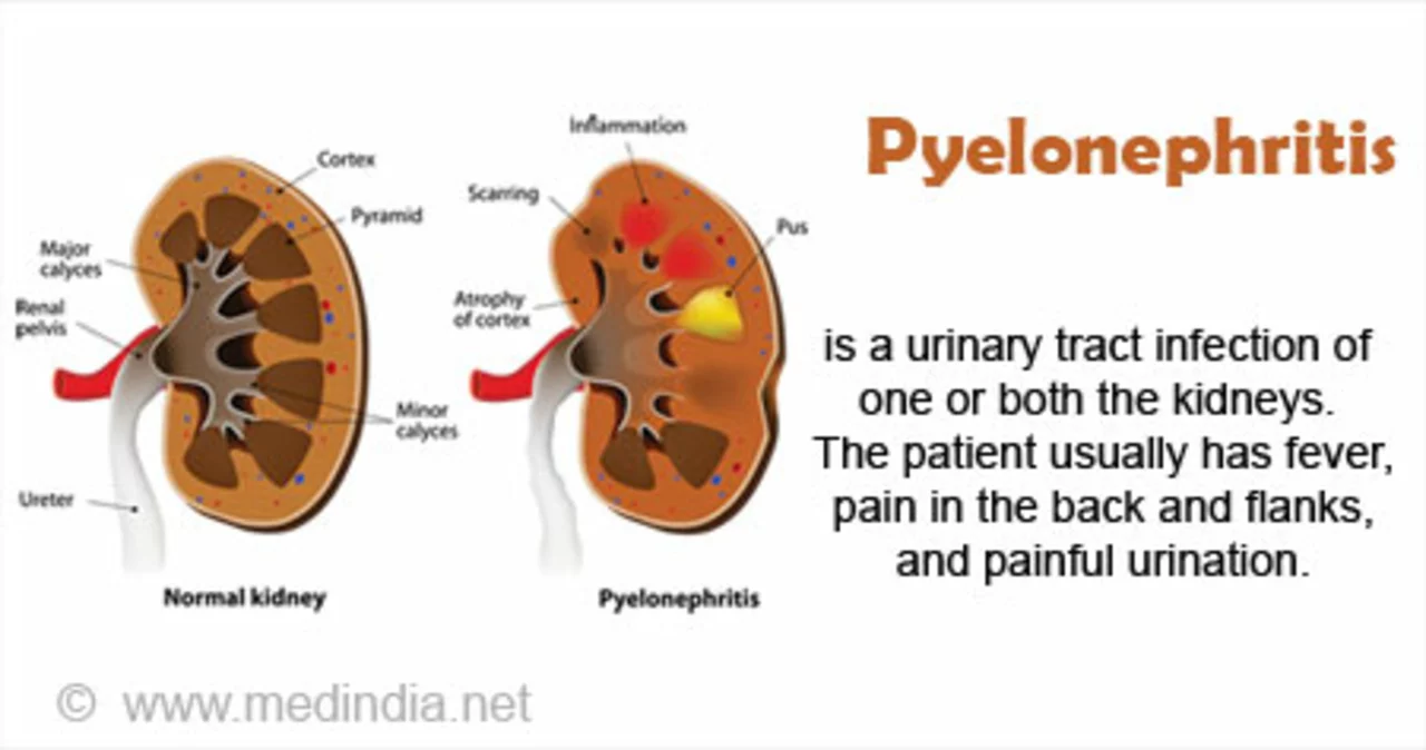 Azithromycin for pyelonephritis: what you should know